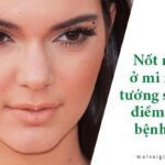 Nốt ruồi ở mi mắt: ý nghĩa tướng số hay điềm báo bệnh tật